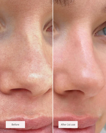 SALICYLIC ACID EXFOLIANT