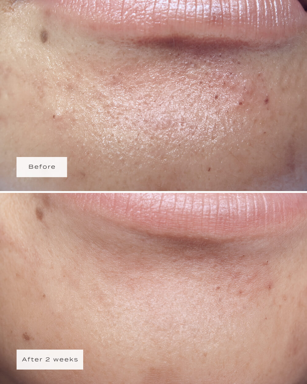 CHIN PATCHES