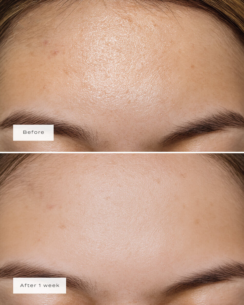 FOREHEAD PATCHES