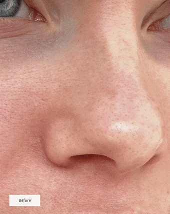 SALICYLIC ACID EXFOLIANT